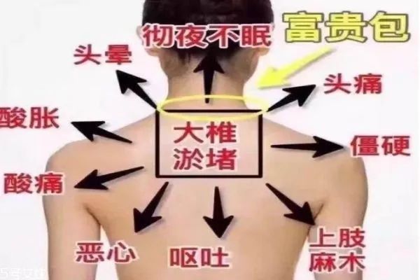 富贵包的克星,艾灸这几个穴,赶紧灸吧!