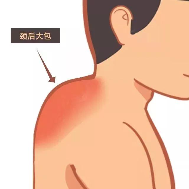 富贵包的克星,艾灸这几个穴,赶紧灸吧!