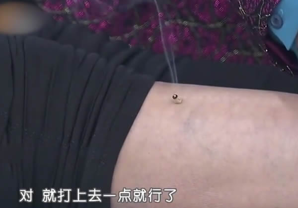 第三章第四节灸后调理与调养