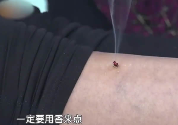 第三章第四节灸后调理与调养