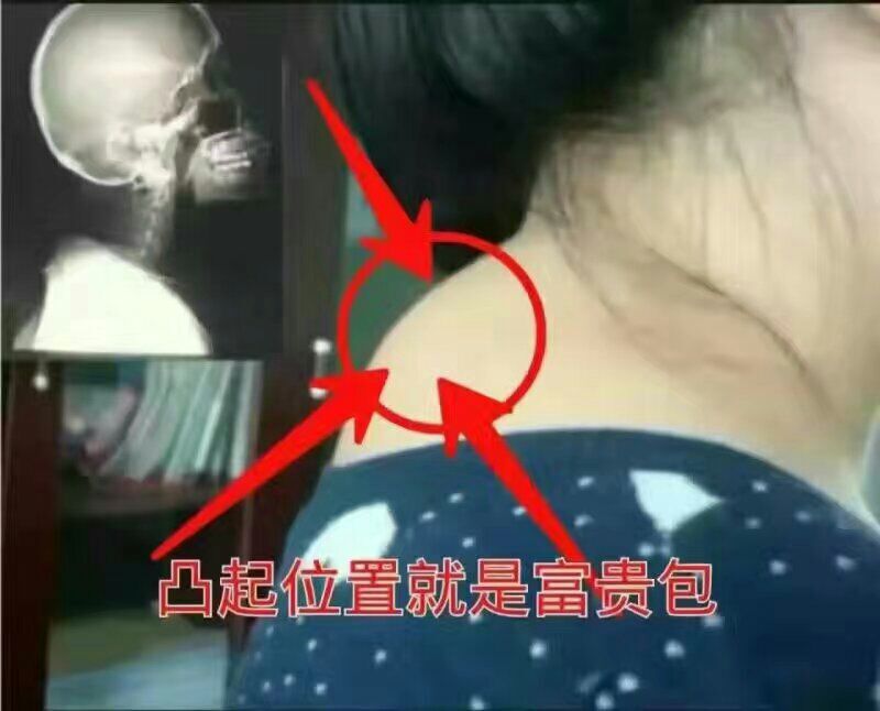 富贵包怎么治疗和消除,艾灸这样操作!