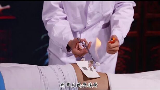 温针灸的功效膝关节炎针灸治疗视频