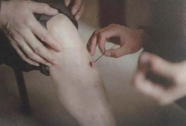 化脓灸足三里,灸足三里化脓了
