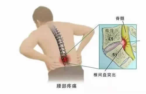 腰间盘突出艾灸疗法