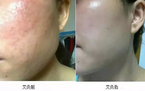 艾灸美容效果怎么样