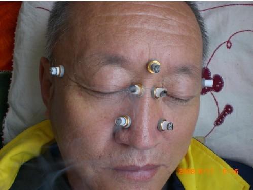艾灸鼻炎根治鼻窦炎