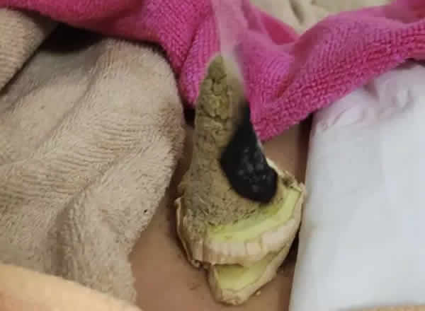 艾灸神阙否极泰来,腰不酸腿不痛吃嘛嘛香的养生