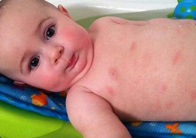 湿疹怎么引起的