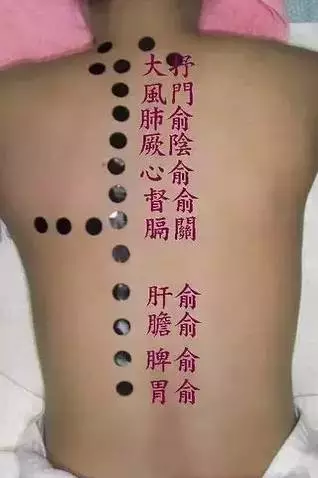 夏季多灸背和腿,夏季是做背部最佳时期!