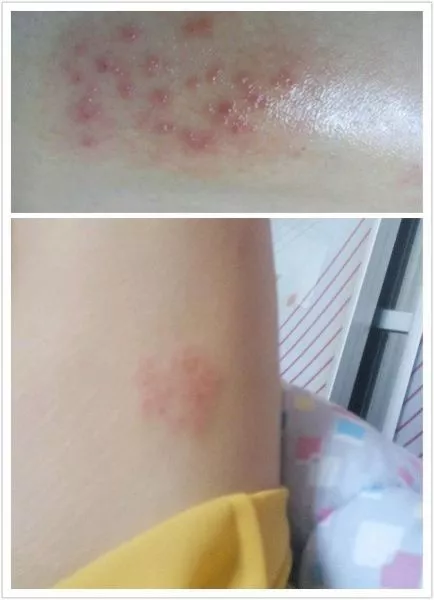 艾灸一下湿疹去无踪,大多数皮肤病都可这样灸