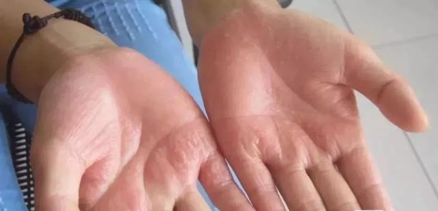 夏天手上就长小水疱?汗疱疹别挑破艾灸止痒防复