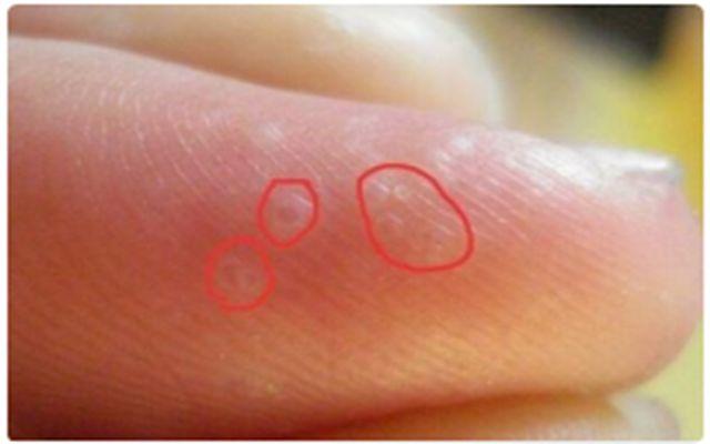 夏天手上就长小水疱?汗疱疹别挑破艾灸止痒防复
