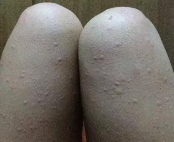 皮肤病艾灸,皮肤病艾灸穴位