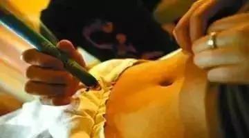 艾灸可以减肥吗