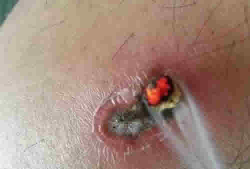 化脓灸,灸疮颜色青黑者风毒未尽