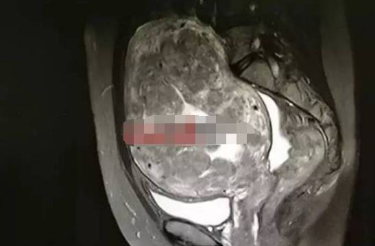子宫肌瘤患者让医生震惊,若早点艾灸