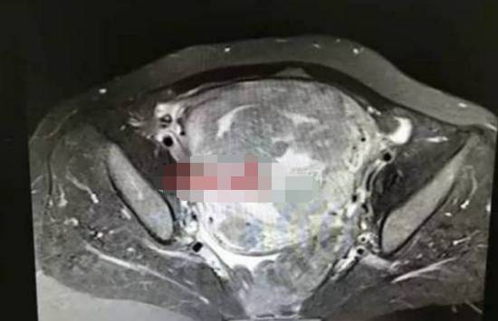 子宫肌瘤患者让医生震惊,若早点艾灸