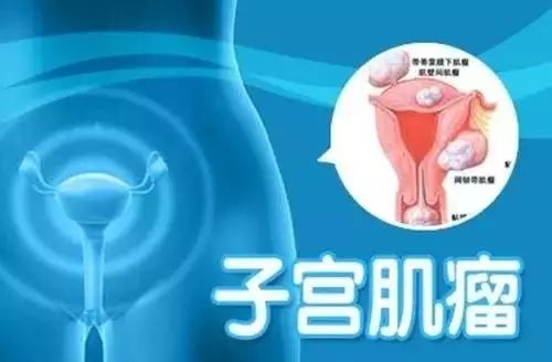 子宫肌瘤的艾灸疗法