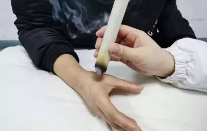 艾灸介入干预新冠病毒肺炎!响应国家号召灸起来