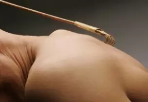 止痒的方法首选艾灸,对皮肤病有奇效!