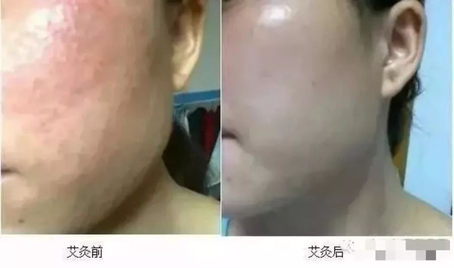 艾灸美容哪些穴位图解