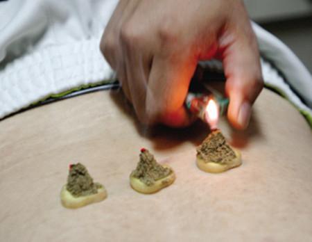 艾灸养生有4种好处3个禁忌,正确调理能健脾养胃