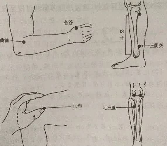 荨麻疹灸法:艾灸这几个穴位治很多皮肤病!