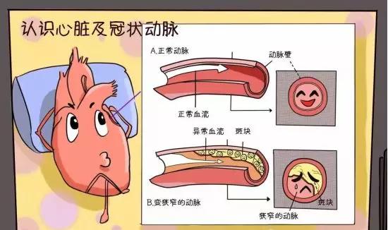 冠心病的预防和艾灸调理