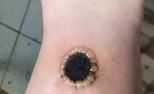 直接灸痛苦但有效!解决痛风就靠艾灸!