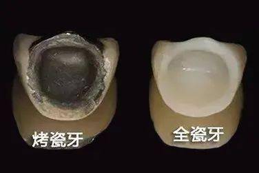 玻璃陶瓷全瓷牙的缺点配图
