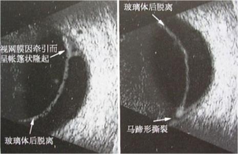 玻璃体后脱离的原因配图