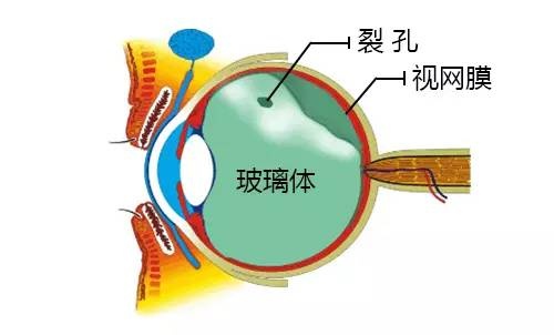 玻璃体可以更换吗配图