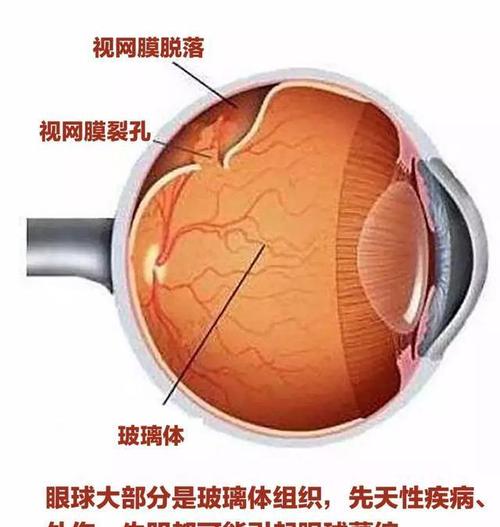 玻璃体可以换人工的吗配图