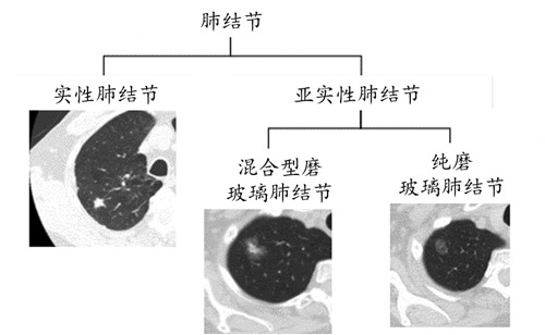 肺部玻璃结节的原因配图