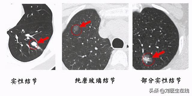 肺部发现小磨玻璃结节是肺癌的几率多大配图