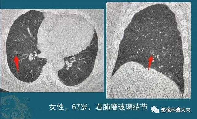 肺部磨玻璃结节的原因是什么配图