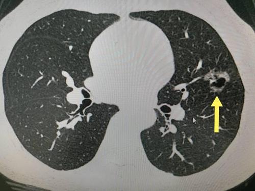 肺部磨玻璃结节是什么原因引起的配图