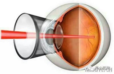更换玻璃体后视力模糊要打激光吗配图