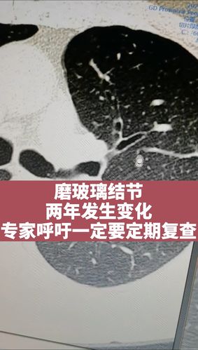 磨玻璃结节的人多吗配图