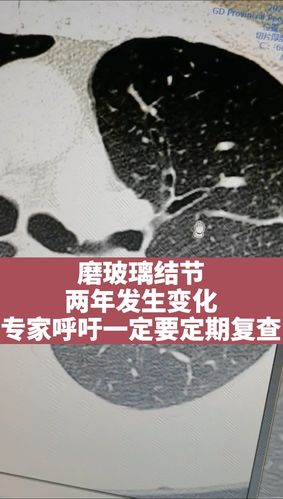 磨玻璃结节的原因配图