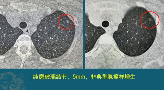 磨玻璃结节是怎样形成的配图