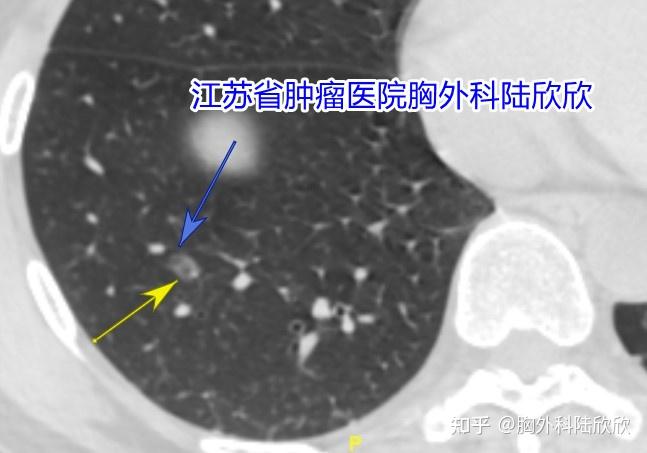 磨玻璃结节形成的原因是什么配图