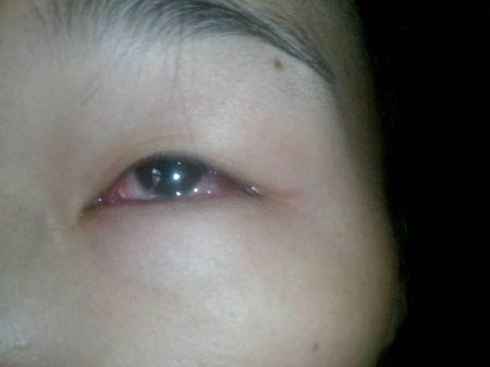 眼睛有玻璃花,像长呲模糊似的膜配图