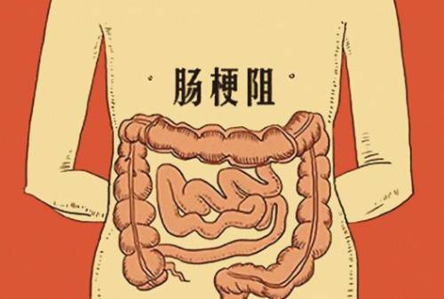 肠道梗阻用什么药配图