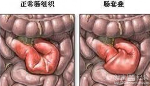 肠梗阻的症状吃什么药好配图