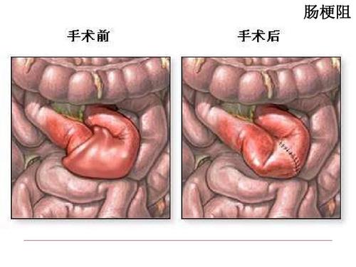 肠梗阻术后发烧是什么原因配图