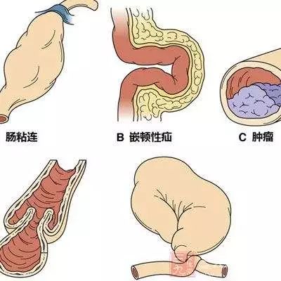 肠梗阻通常发生在什么部位配图