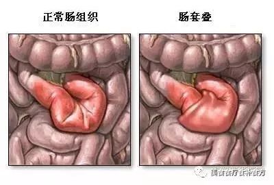 肠梗阻要注意什么配图