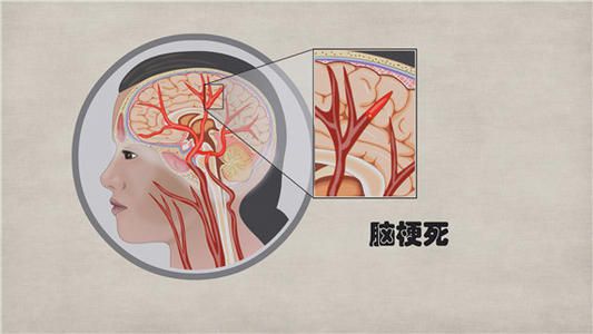 出现腔隙性脑梗塞的原因是什么配图