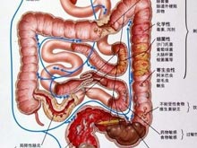 大肠梗塞是什么症状配图